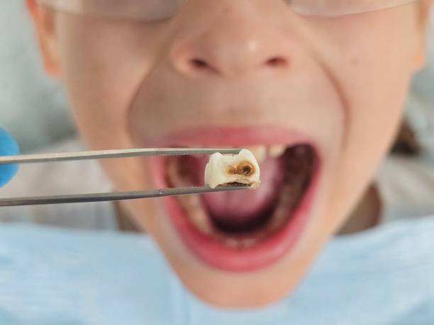 Best Emergency Tooth Extraction  in Bellevue, IA