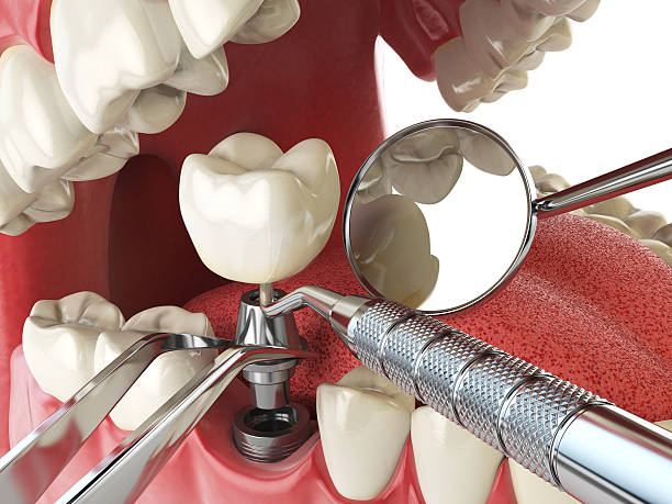 Best Dentist for Tooth Abscess  in Bellevue, IA